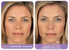 nasoloabial smile line fillers botox long island hempstead